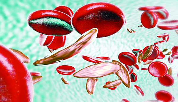 Any-alert-on-sickle-cell