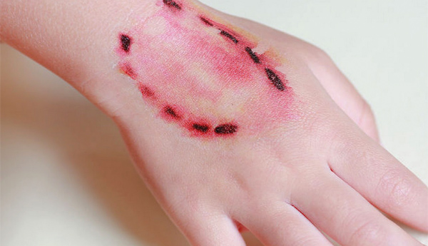 bite