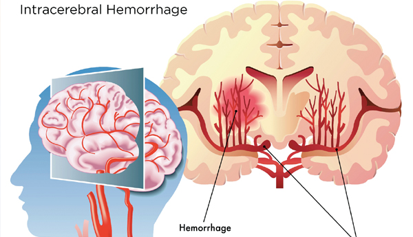 heart-attack-article-causes-precautions-awareness-bp